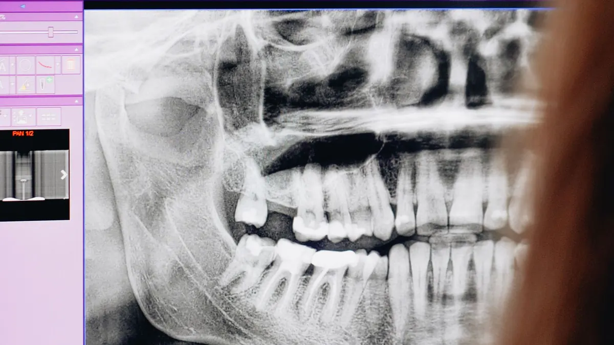 Panoramic dental X-ray open in imaging software on a workstation monitor